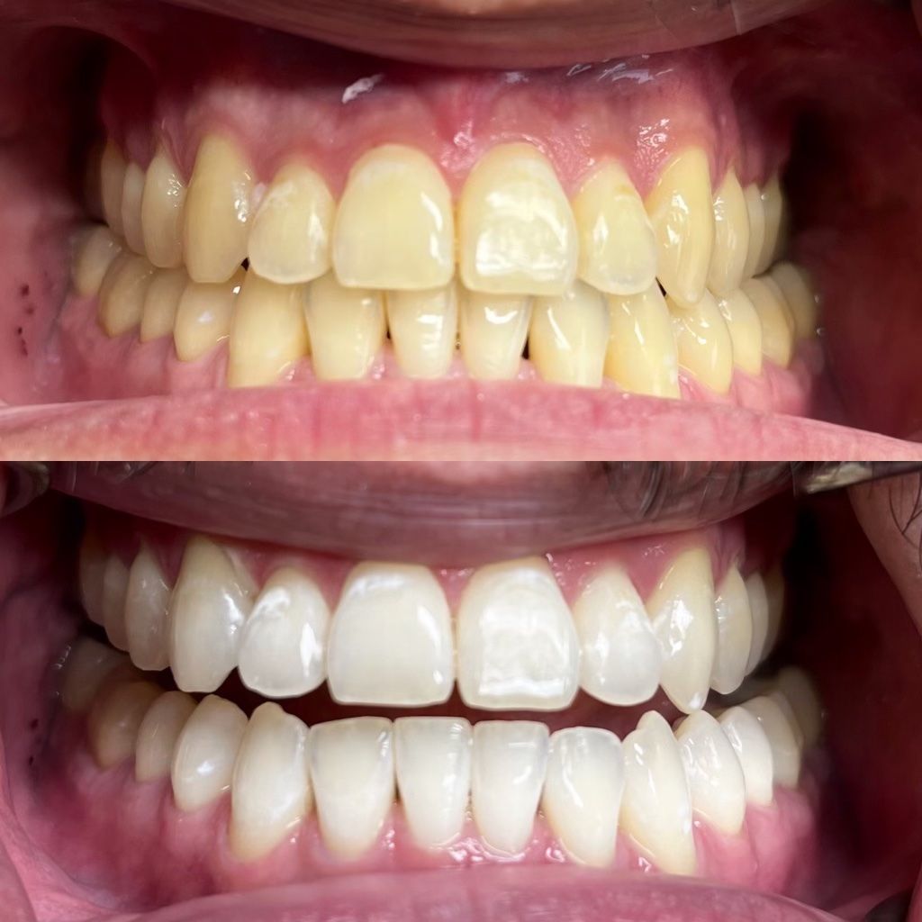 Teeth Whitening